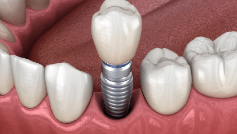 Root Canal vs. Extraction: What’s the Right Emergency Fix?