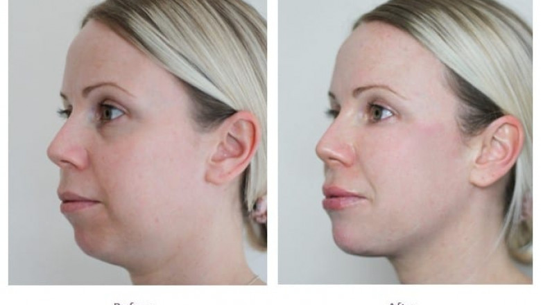 Best Plastic Surgeon in dubai for Jawline Fillers: What is the Ideal Fillers Type?