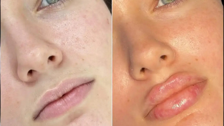 Get Plump and Youthful Skin with the Best Plastic Surgeon in Dubai for Fillers