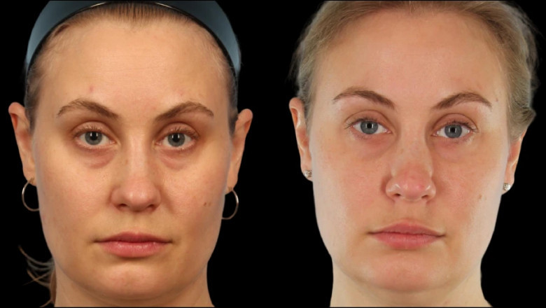 How to Find the Right Under Eye Fillers Treatment in Dubai Clinic