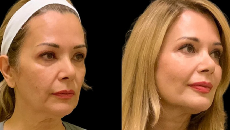 The Safety Protocols in Place for Cheek Fillers Treatment in Dubai