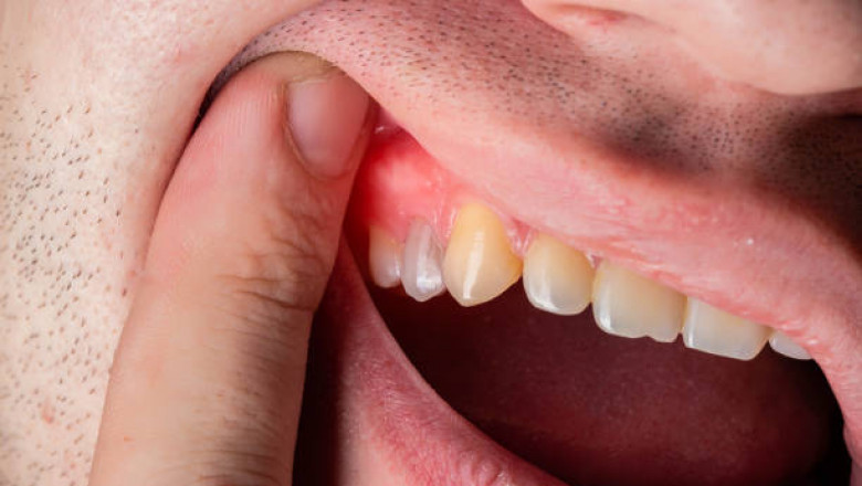 Why Immediate Care Is Critical for Knocked-Out Teeth